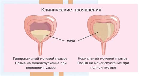 Диагностика тура мочевого пузыря у женщин