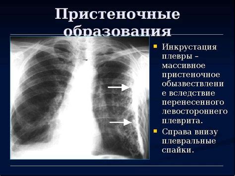 Диагностика уплотнения междолевой плевры