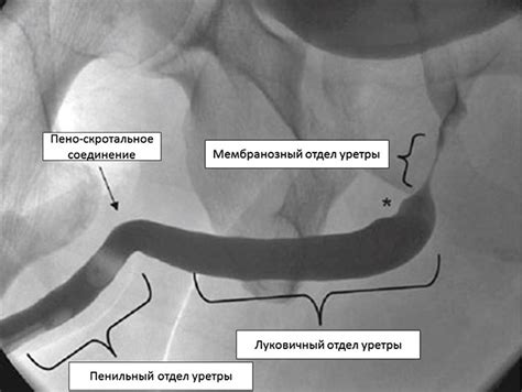 Диагностика уретры фибрина