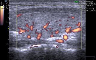 Диагностика усиленного кровотока в щитовидной железе