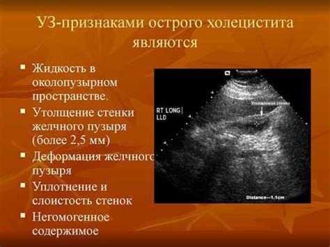 Диагностика утолщения междолькового интерстиция