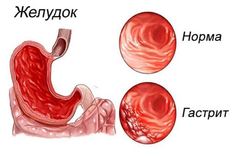 Диагностика хронического гастрита