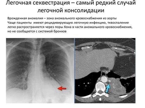 Диагностические методы для определения тяжелой консолидации легочной ткани