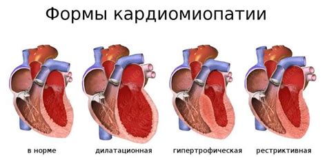 Дилатационная кардиомиопатия