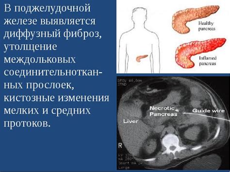 Диффузные изменения поджелудочной железы: виды и их клиническое значение