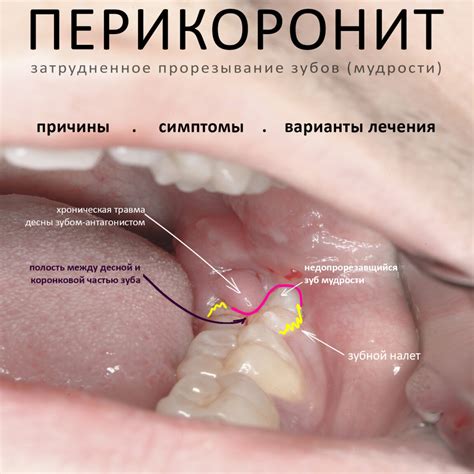 Долгосрочные последствия отсутствия зубов мудрости