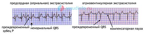 Дополнительные симптомы наджелудочковой экстрасистолии