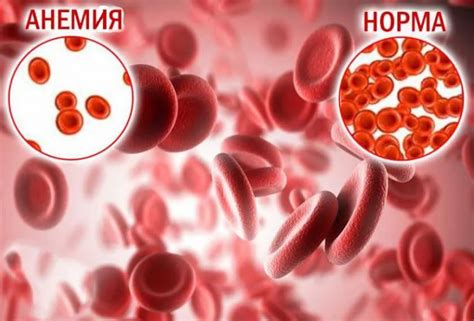 Железодефицитная анемия: диагностика и лечение