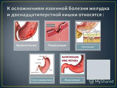 Желудочное кровотечение: возможные проявления простуды