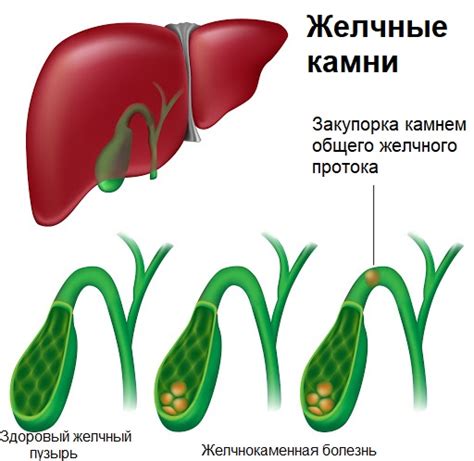 Желчнокаменная болезнь