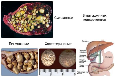 Желчный камень: симптомы и лечение