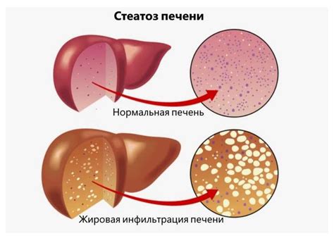 Жировая дистрофия печени и ее проявления на УЗИ