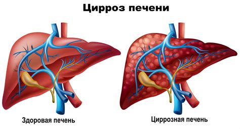 Заболевания печени, вызывающие повышение уровня алкалиновой фосфатазы ALP