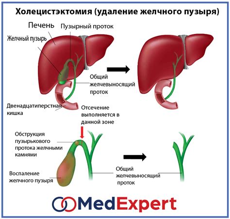 Загиб желчного пузыря у взрослых: