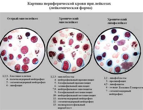 Значение анализа мазка периферической крови в диагностике заболеваний