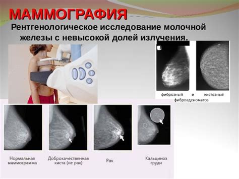 Значение голоядерных клеток в диагностике рака молочной железы