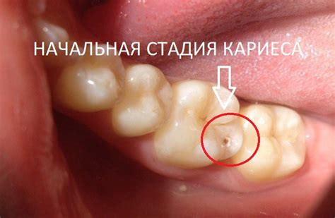 Значение кариеса на зубе в контексте психологии