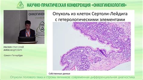 Значение лимфоидной инфильтрации стромы опухоли