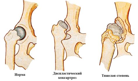 Значение линии Шентона