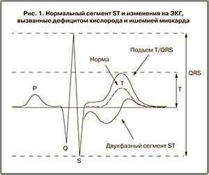 Значение показателя 8 баллов в результатах КТГ