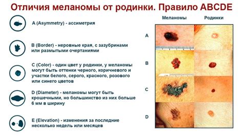 Значение родинки внизу живота