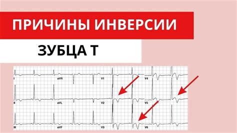 Значение экг инверсии зубца Т для сердечного здоровья