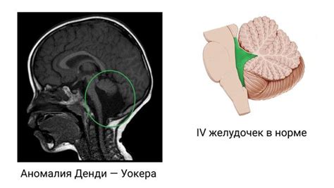 Значения ретроцеребеллярной арахноидальной кисты у ребенка