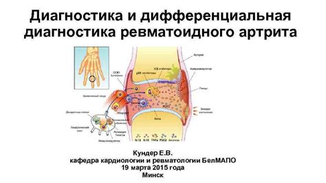 Значимость показателя ревматоидного фактора в ревматологии