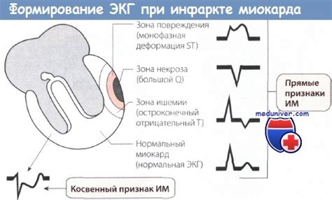 Зубец Q: сущность и назначение