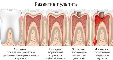 Зубные проблемы: кариес и зубной воспаление