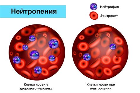 Избыточное количество нейтрофилов: что это значит?