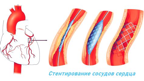 Излишние физические нагрузки: фактор расширения стенок сердца