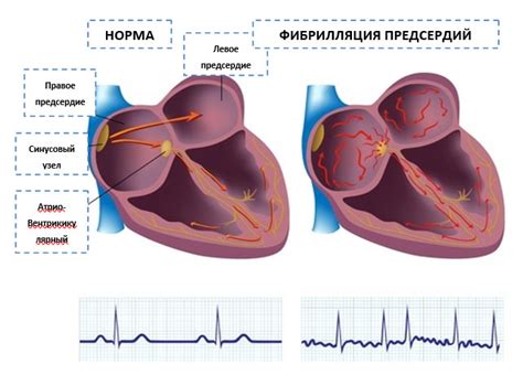 Изменение предсердий на ЭКГ: понятие и значение