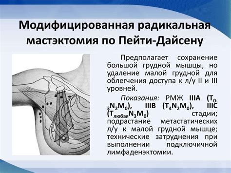 Индикации для проведения мастэктомии по Маддену