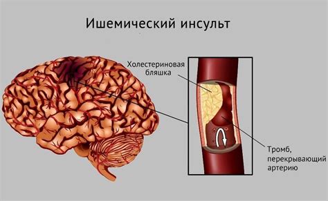 Инсульт: определение и классификация