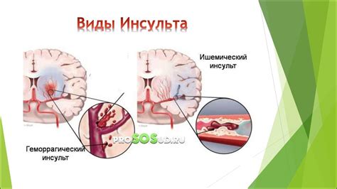 Инсульт и эмоции: влияние психологического состояния на сны о инсультах