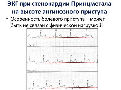 Интерпретация ЭКГ без существенной динамики