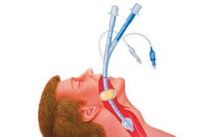 Интубация пациента: основное понятие и значение