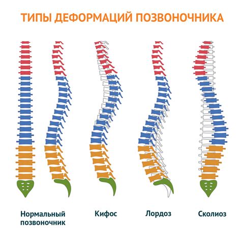 Искривление позвоночника