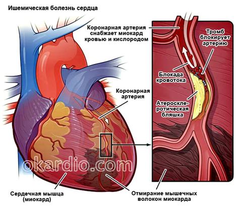 Ишемическая болезнь сердца и ее влияние на сердечный ритм