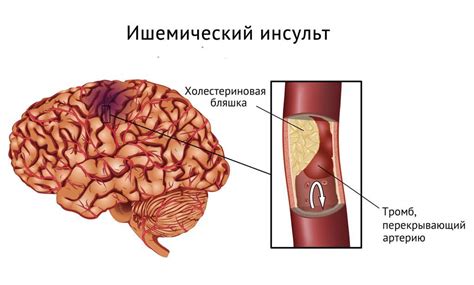 Ишемический инсульт головного мозга