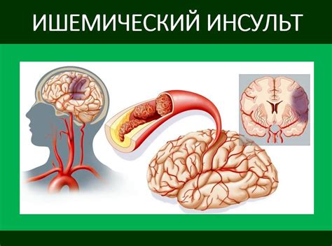 Ишемический тип нарушения мозгового кровообращения