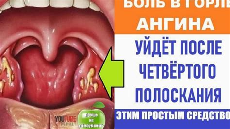 Йодное намазывание на горло: основные эффекты и последствия