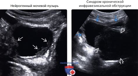 Какая информация получается при С УЗИ 5 отверстий?