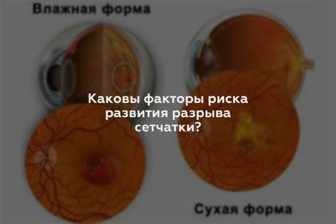 Какие бывают причины разрывов сетчатки?