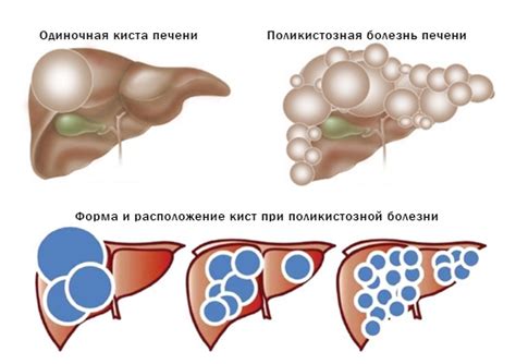 Какие методы лечения кисты печени с перегородками существуют?