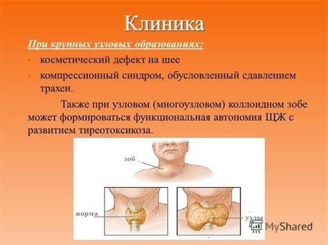 Какие осложнения могут возникнуть при коллоидном зобе В2?