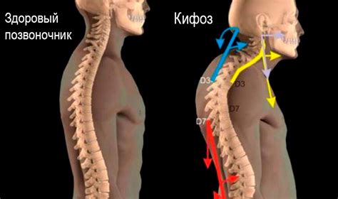 Какие последствия может вызывать выраженный изгиб позвоночника?