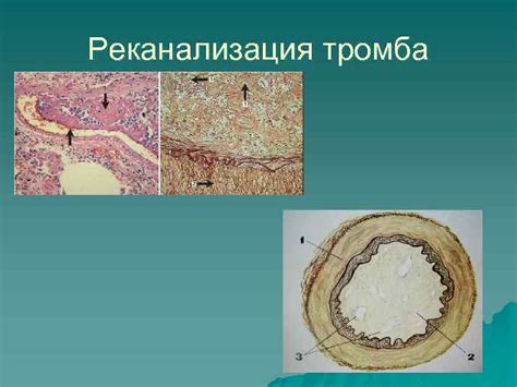 Какие последствия может иметь начальная реканализация тромба?