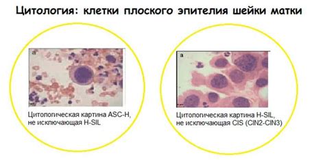 Какие последствия может иметь плохая цитология мазка?